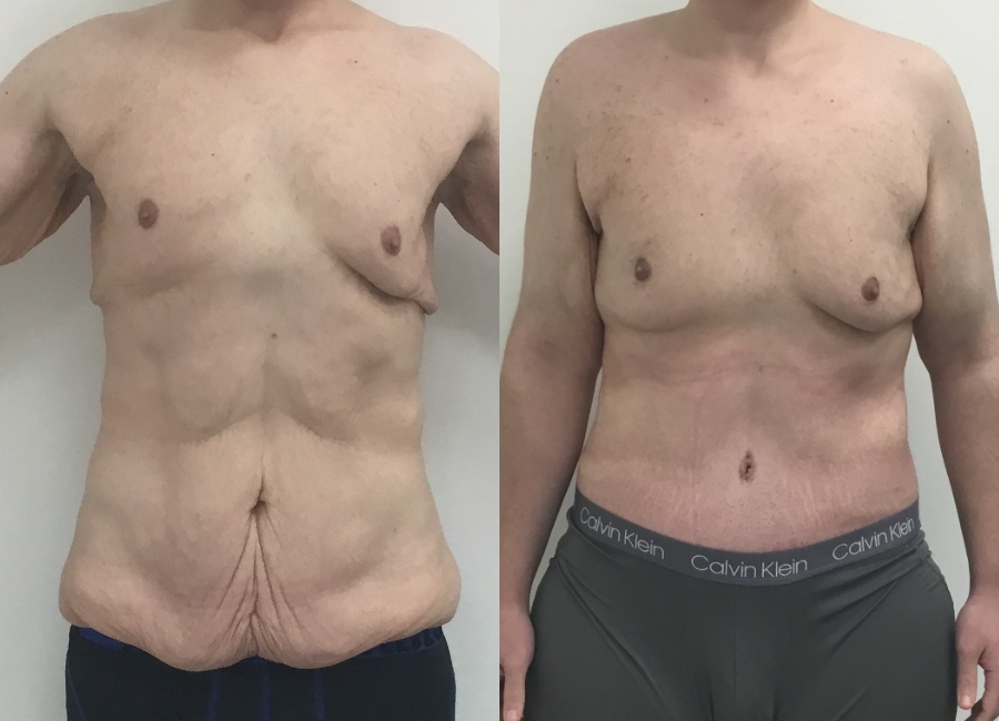 This is one of our beautiful post-bariatric body contouring patient 37