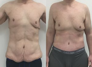 This is one of our beautiful tummy tuck patient 67