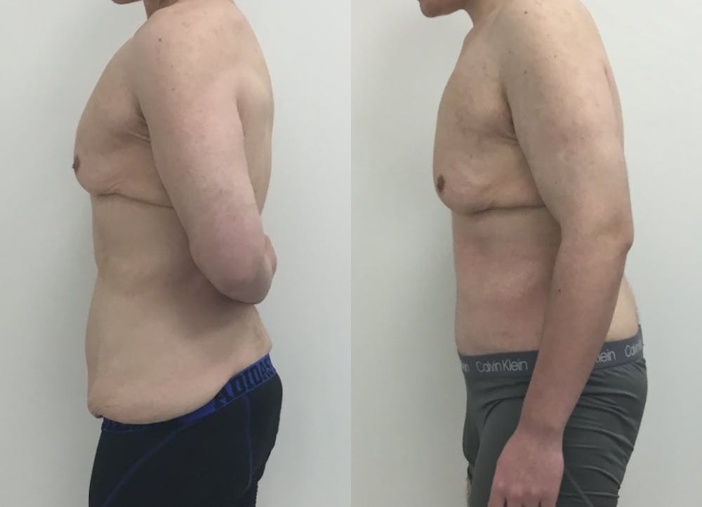 This is one of our beautiful tummy tuck patient #67
