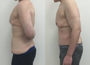 This is one of our beautiful tummy tuck patient 67