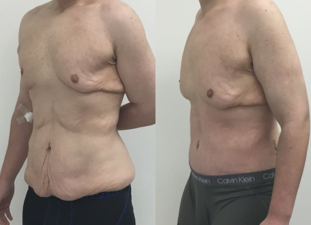 This is one of our beautiful tummy tuck patient #67