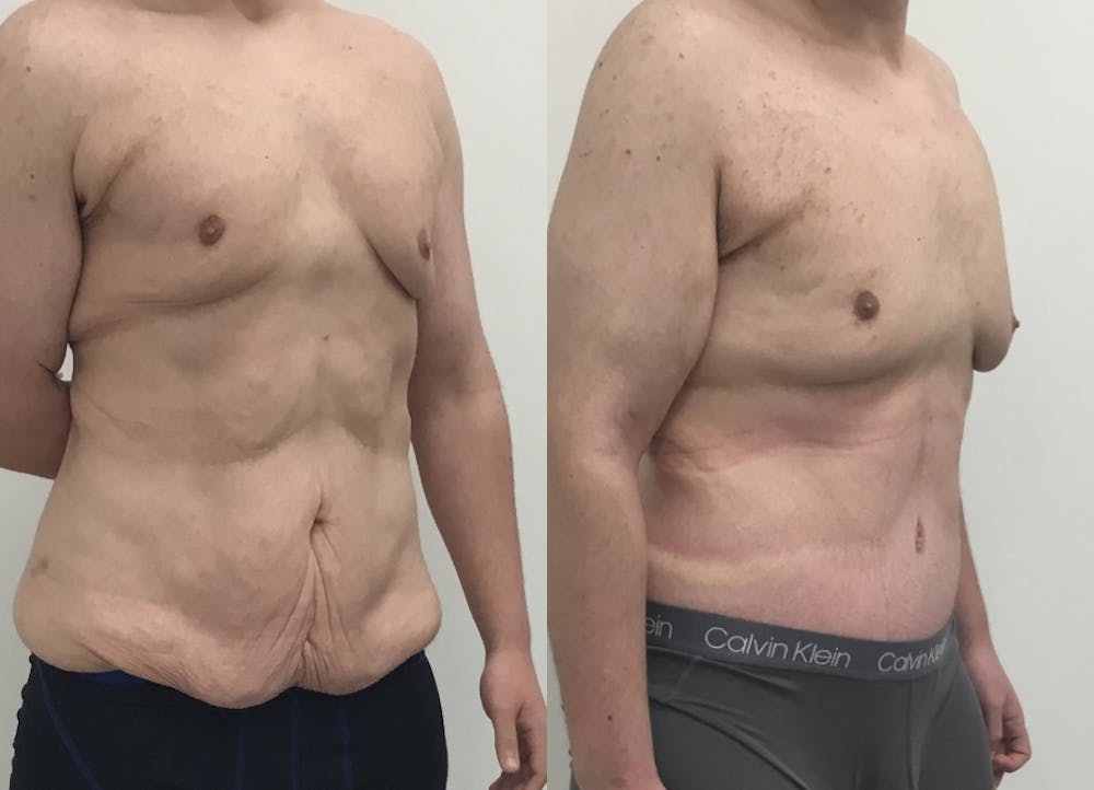 This is one of our beautiful tummy tuck patient #67
