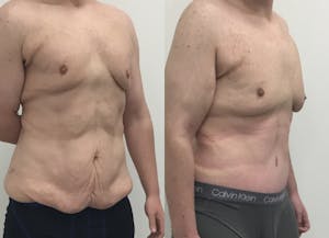 This is one of our beautiful tummy tuck patient 67