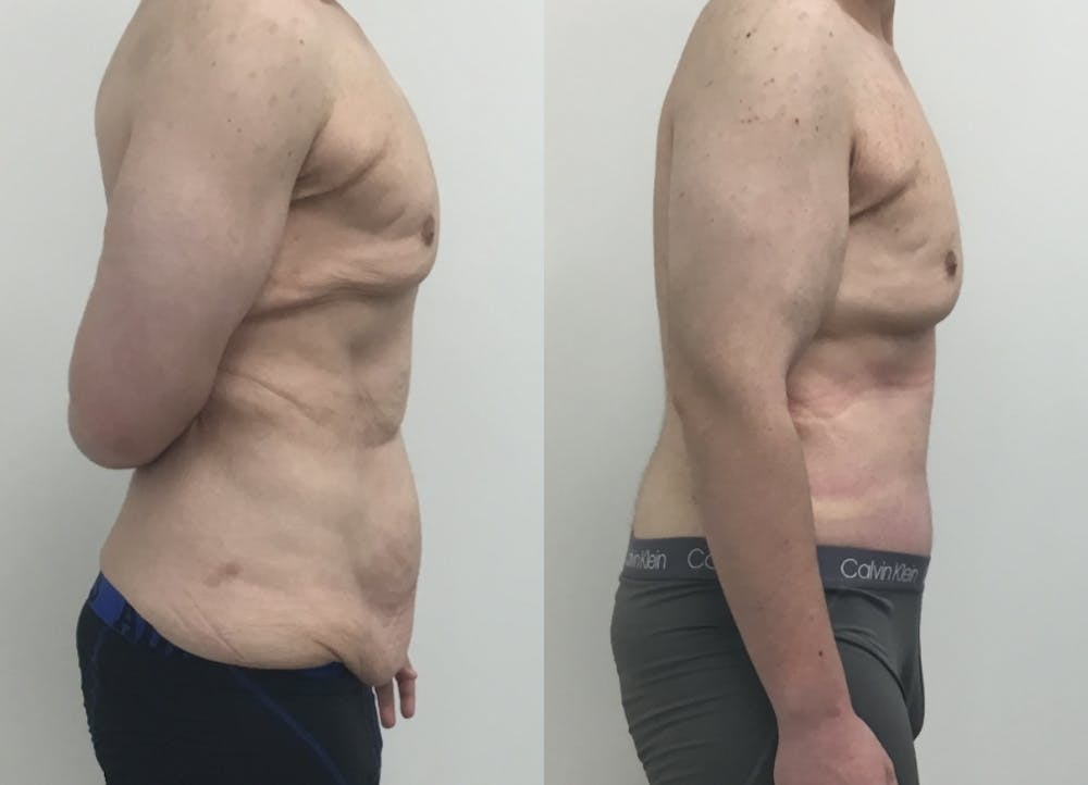 This is one of our beautiful tummy tuck patient #67