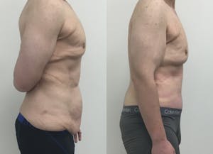 This is one of our beautiful tummy tuck patient 67