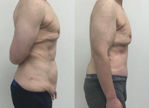 This is one of our beautiful post-bariatric body contouring patient 37