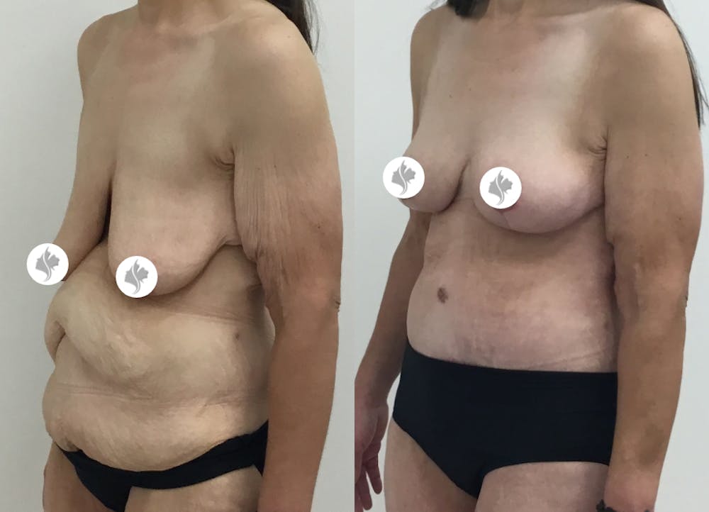 This is one of our beautiful tummy tuck patient #68