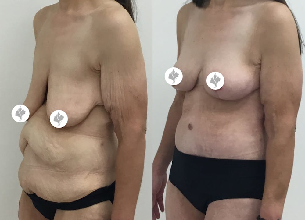 This is one of our beautiful post-bariatric body contouring patient #39