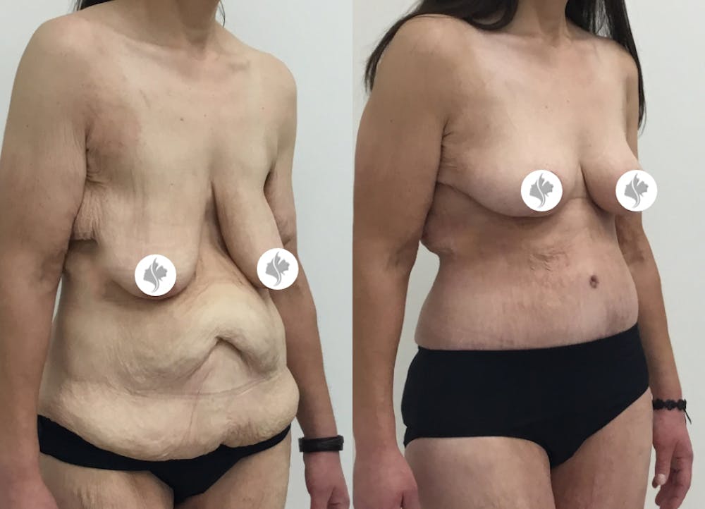 This is one of our beautiful post-bariatric body contouring patient #39