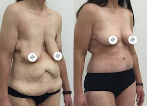 This is one of our beautiful post-bariatric body contouring patient 39