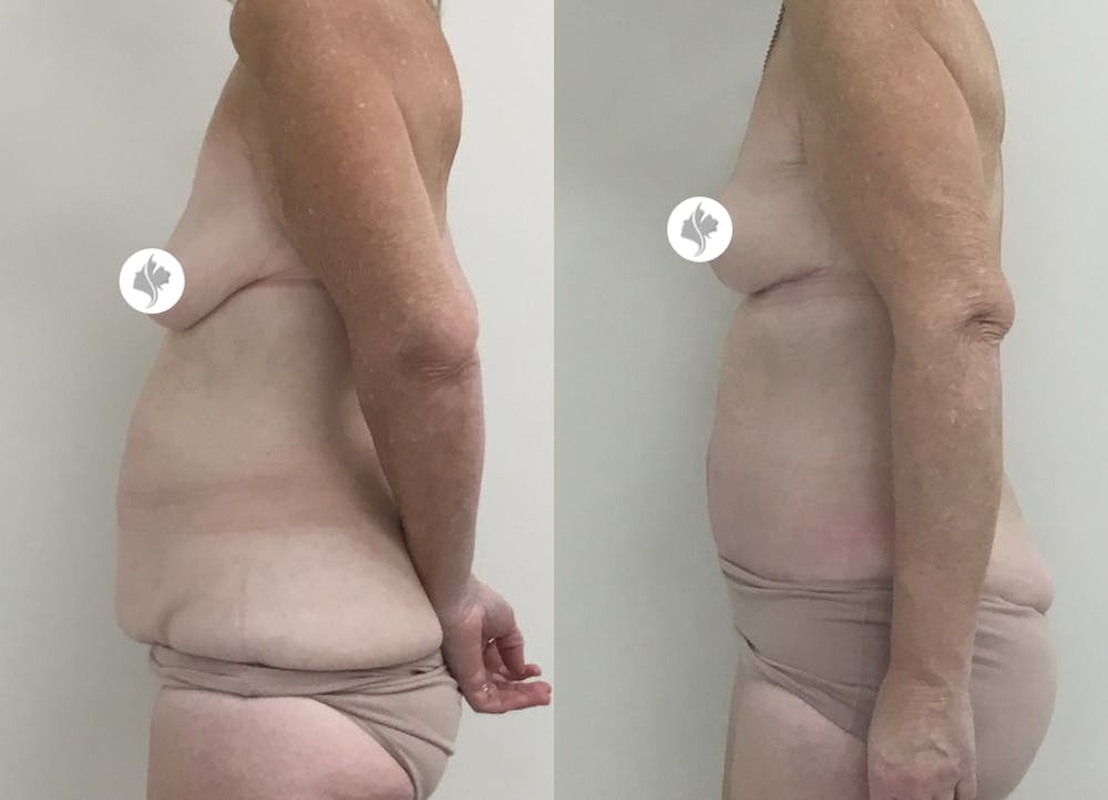 This is one of our beautiful tummy tuck patient #73