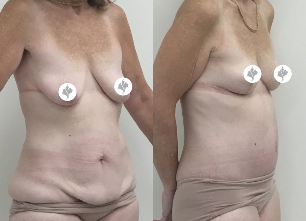 This is one of our beautiful tummy tuck patient #73