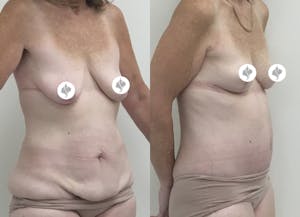 This is one of our beautiful tummy tuck patient 69