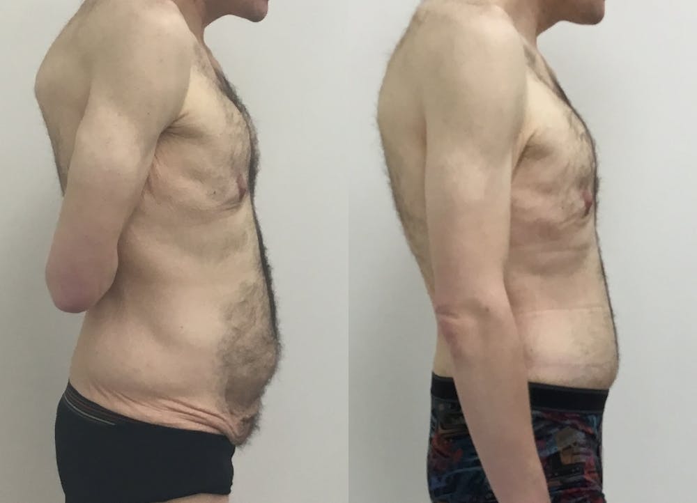 This is one of our beautiful tummy tuck patient #70