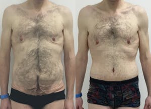 This is one of our beautiful tummy tuck patient 70