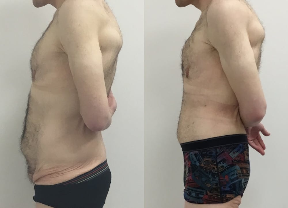This is one of our beautiful tummy tuck patient #70