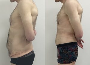 This is one of our beautiful tummy tuck patient 70