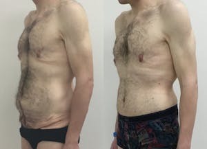 This is one of our beautiful tummy tuck patient 70