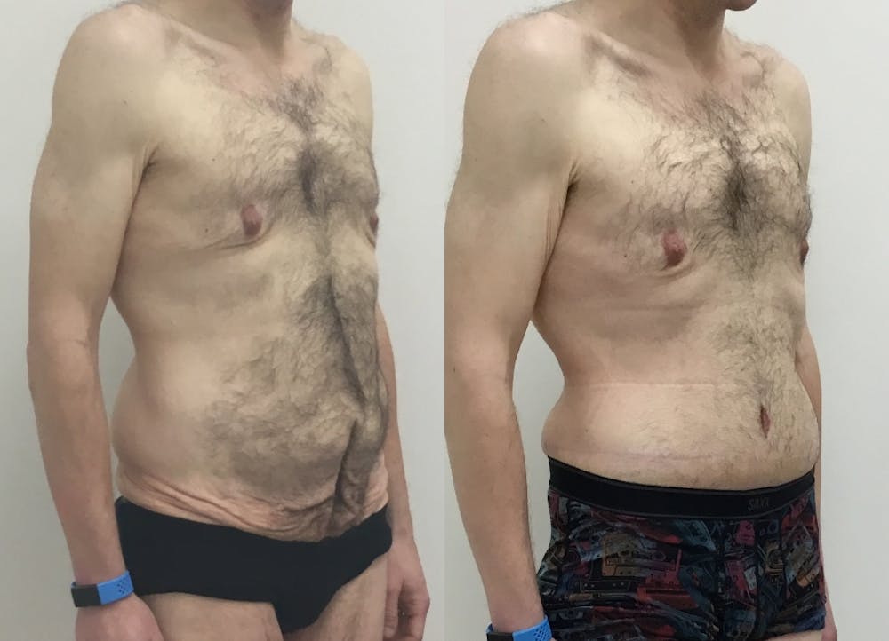 This is one of our beautiful tummy tuck patient #70