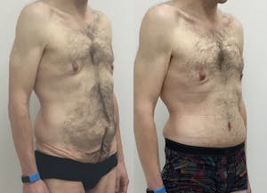 This is one of our beautiful tummy tuck patient 70