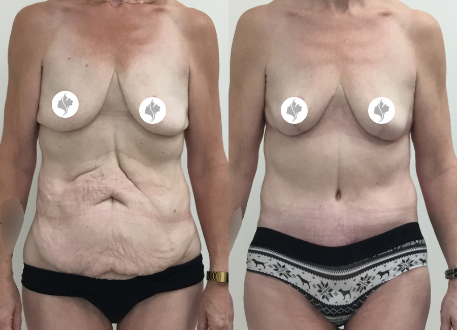This is one of our beautiful tummy tuck patient 75