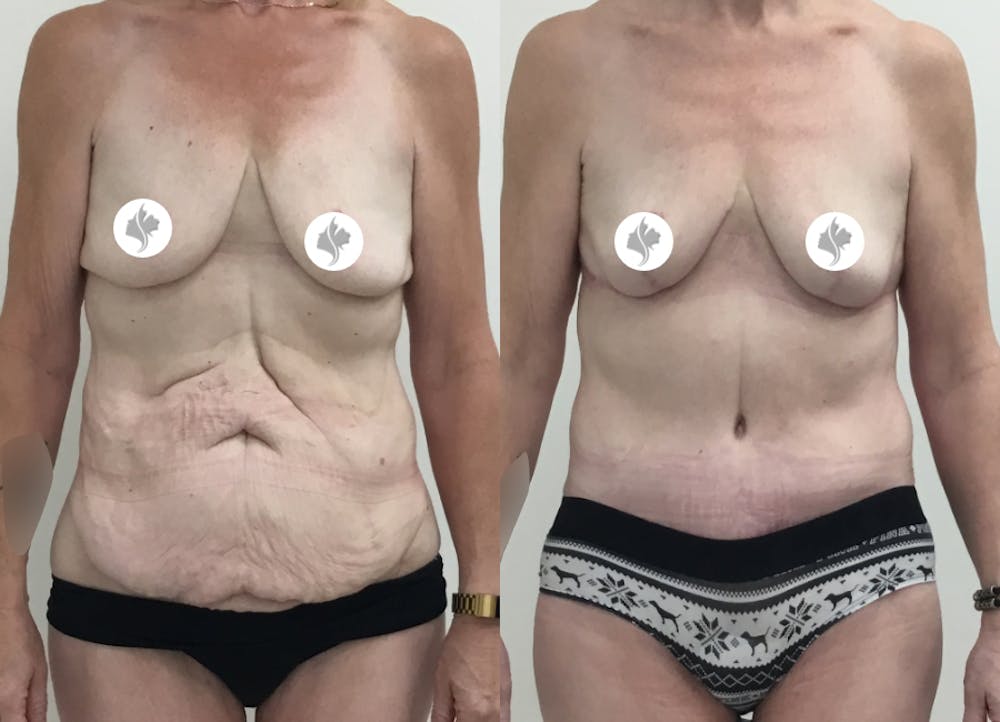 This is one of our beautiful tummy tuck patient #71