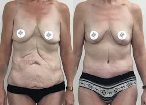 This is one of our beautiful tummy tuck patient 71