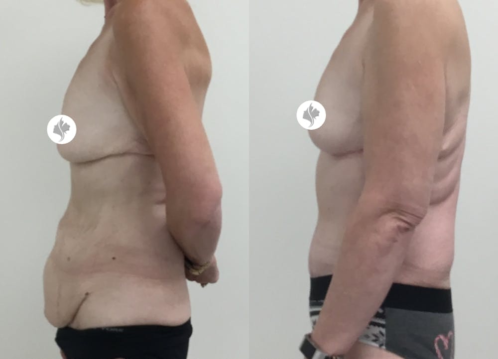 This is one of our beautiful tummy tuck patient #71