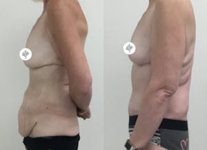 This is one of our beautiful tummy tuck patient 71