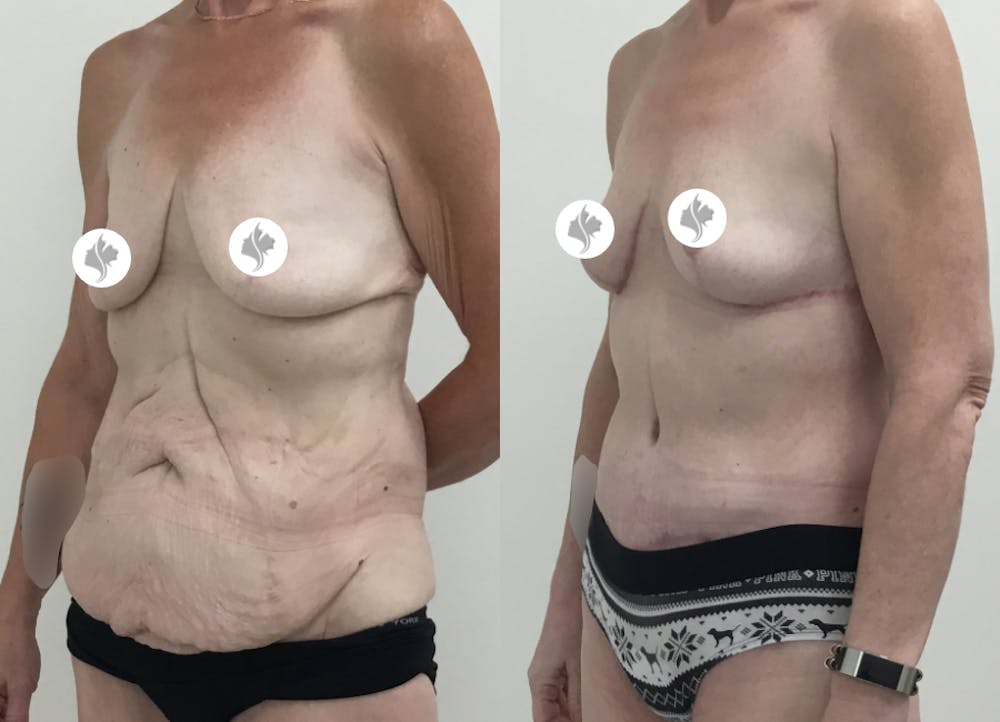 This is one of our beautiful tummy tuck patient #75