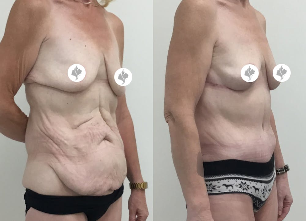 This is one of our beautiful tummy tuck patient #71