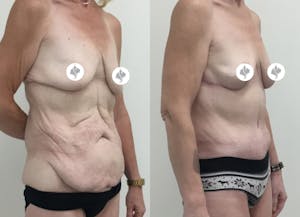 This is one of our beautiful tummy tuck patient 71