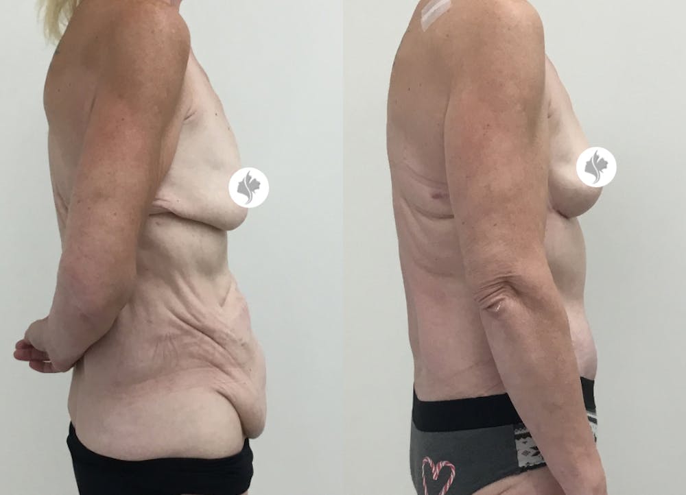 This is one of our beautiful tummy tuck patient #71