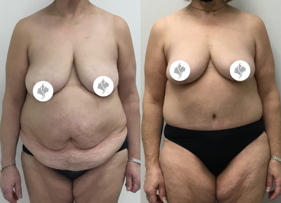 This is one of our beautiful post-bariatric body contouring patient 41