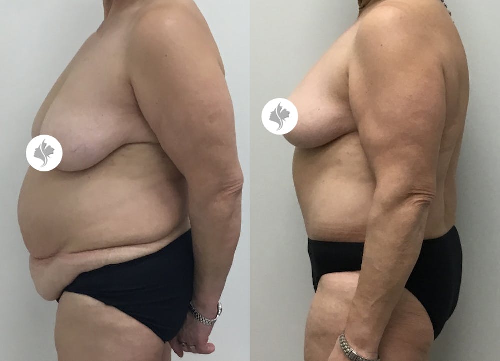 This is one of our beautiful post-bariatric body contouring patient #41