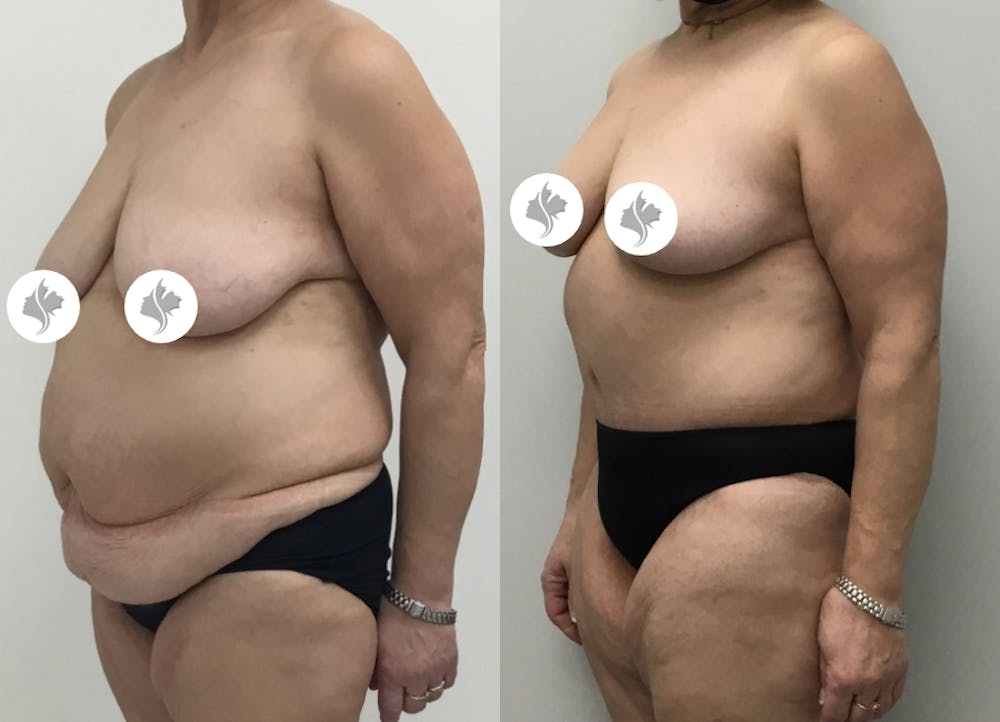 This is one of our beautiful tummy tuck patient #72
