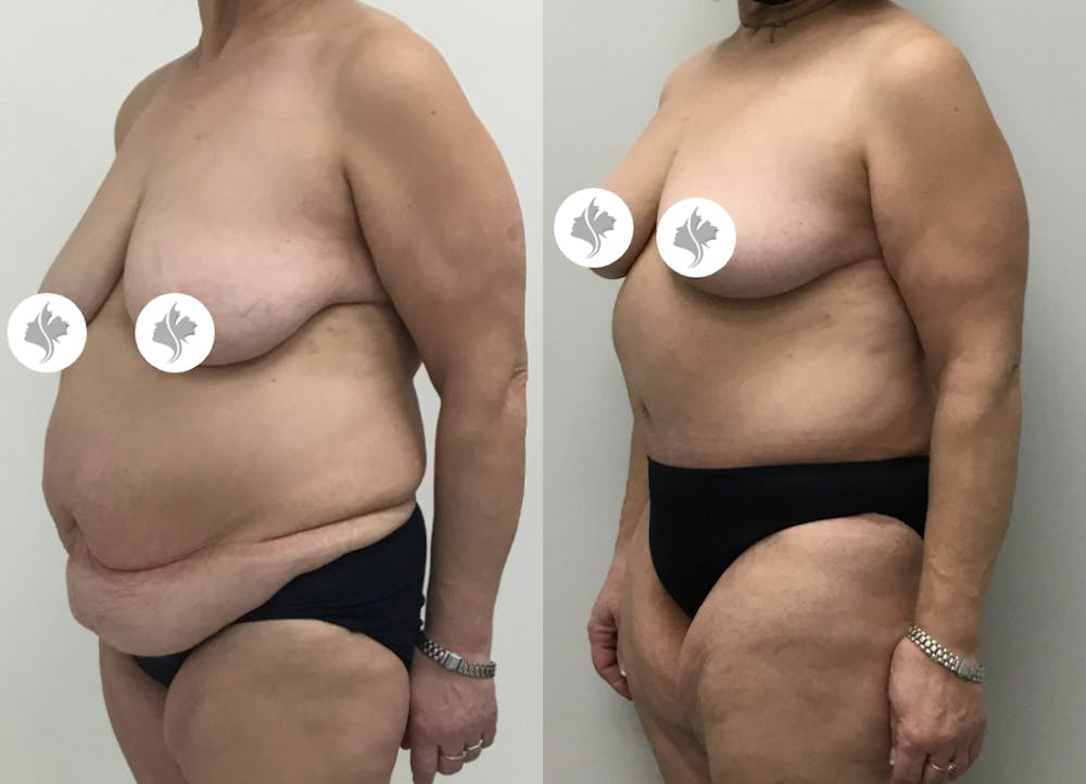 This is one of our beautiful post-bariatric body contouring patient #41