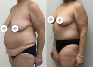 This is one of our beautiful tummy tuck patient 72