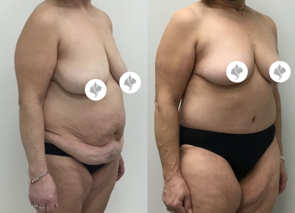 This is one of our beautiful tummy tuck patient #72