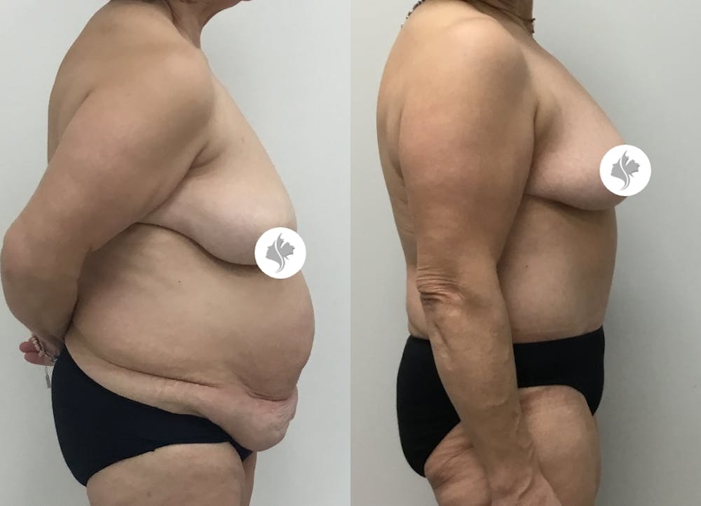 This is one of our beautiful post-bariatric body contouring patient #41