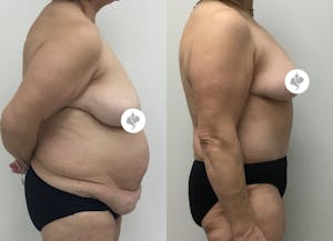 This is one of our beautiful post-bariatric body contouring patient 41