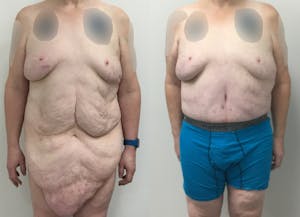 This is one of our beautiful post-bariatric body contouring patient 42