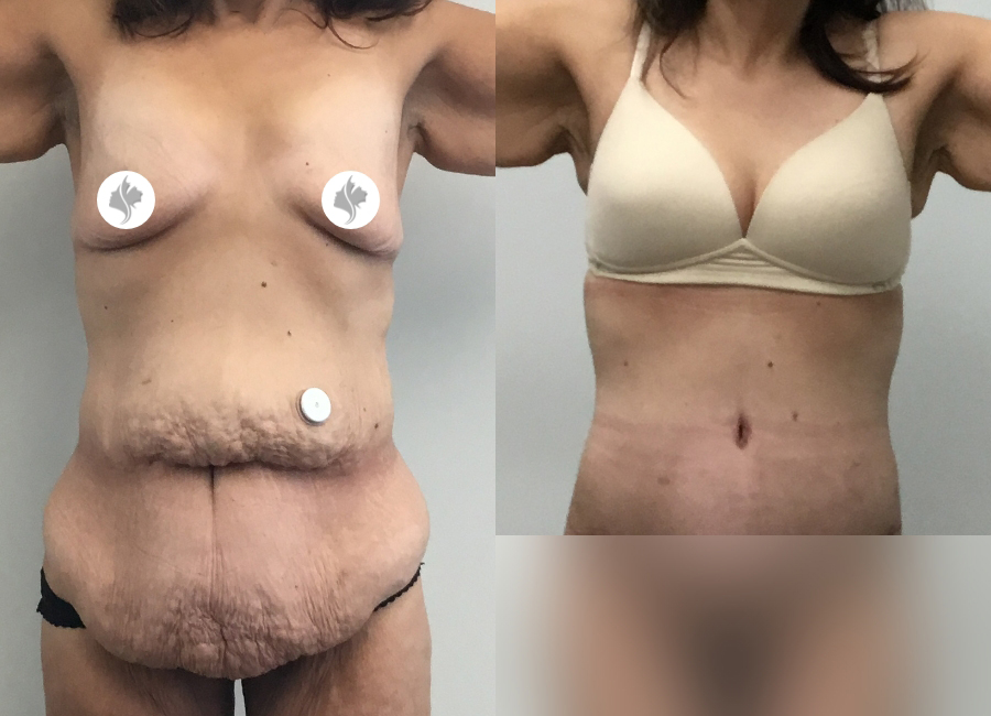 This is one of our beautiful tummy tuck patient 79