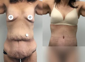 This is one of our beautiful post-bariatric body contouring patient 43