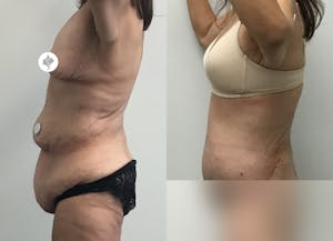 This is one of our beautiful post-bariatric body contouring patient 43