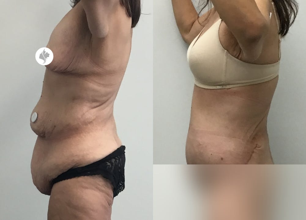 This is one of our beautiful post-bariatric body contouring patient #43