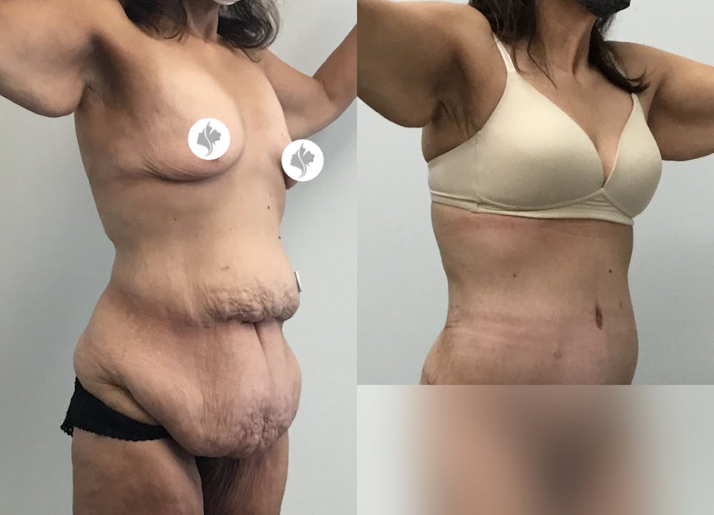 This is one of our beautiful tummy tuck patient #75