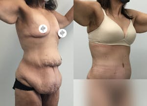 This is one of our beautiful post-bariatric body contouring patient 43