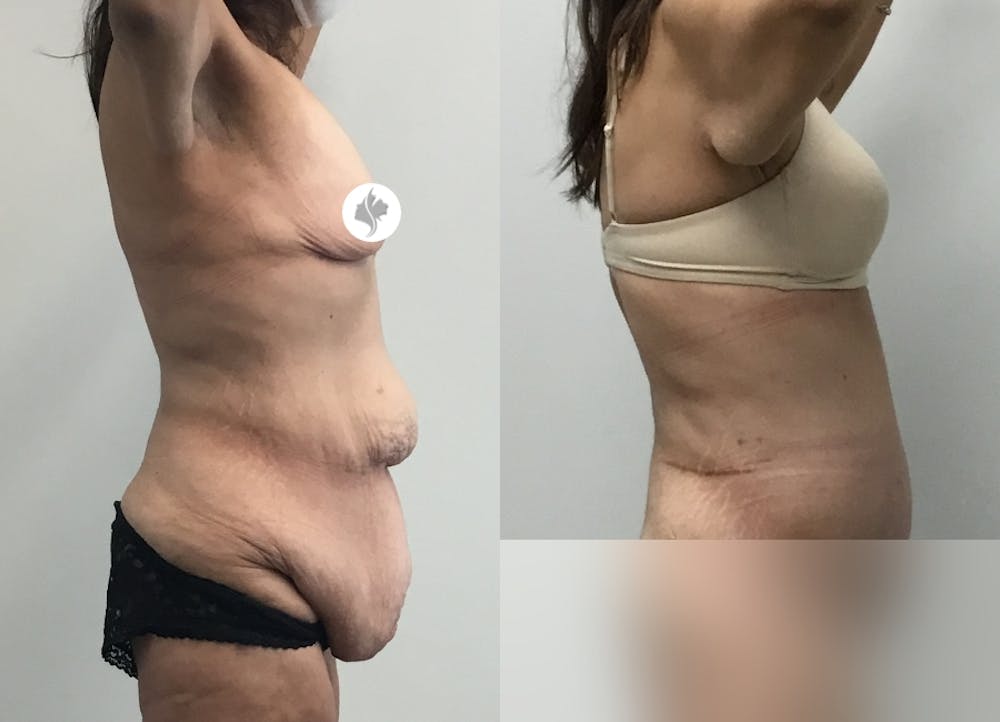 This is one of our beautiful tummy tuck patient #79