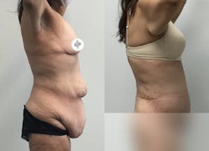 This is one of our beautiful post-bariatric body contouring patient 43